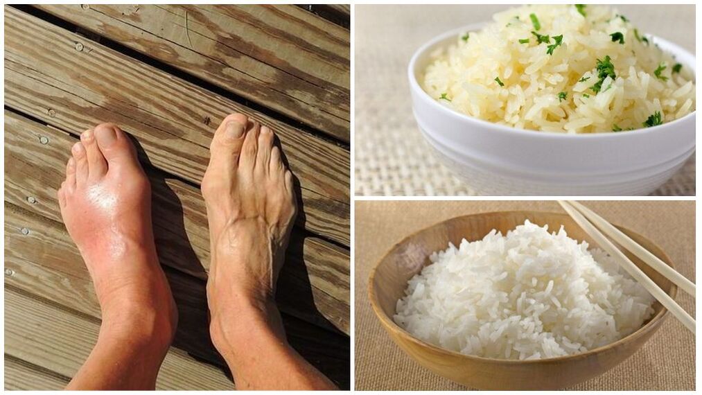 En risbaserad kost rekommenderas för giktpatienter. 
